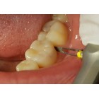 PROFIN DIERCTIONAL SYSTEM  ΟΔΟΝΤΙΑΤΡΙΚΑ