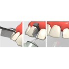 FENDERWEDGE PREP  ΟΔΟΝΤΙΑΤΡΙΚΑ